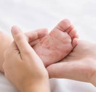 Biologics and Small Molecules in Pediatric Dermatology: Emerging Clinical Evidence