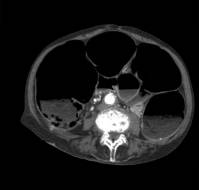 Ogilvie’s Syndrome Post-Cesarean: Recognizing a Silent Surgical Threat