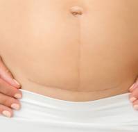 Evaluating Post-Cesarean Wound Healing and Scar Outcomes with Subcuticular Closure