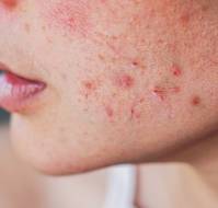 Hidradenitis Suppurativa in Women: Beyond the Skin