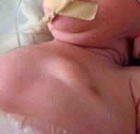 Axillary Web Syndrome in a Child Without Prior Surgery: A Rare Case