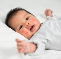 Pediatric Atopic Dermatitis and Biologics: Suitability in the Under-6 Age Group