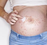 Managing Pruritus in Pregnancy: Evaluating Safe and Integrative Treatment Options