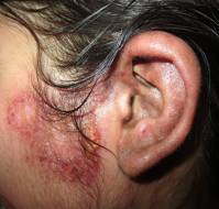 Kikuchi–Fujimoto Disease in Children: Case Report and Diagnostic Insights