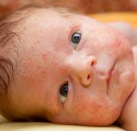  Pediatric Eczema: Diagnosis and Treatment Insights