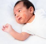 New Review Reveals Gaps in Atopic Dermatitis Guidelines for Children, Especially Those with Skin of Colour
