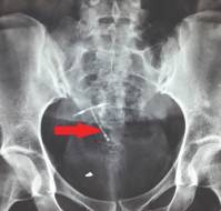 Retrieval of a missing translocated IUD using combined laparoscopic and cystoscopic techniques