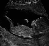 Nuchal Translucency Measurements in Prenatal Screening: Revisiting NT Cut-Offs