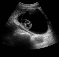 Characterization of resolution of incident ovarian cysts