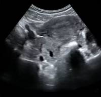 A Rare Case of Ectopic Molar Pregnancy