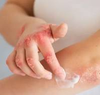 Emollient Use in Preventing Atopic Dermatitis – What Does the Evidence Say?