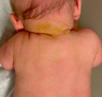 Epidermolytic Ichthyosis in a Neonate: A Case Study