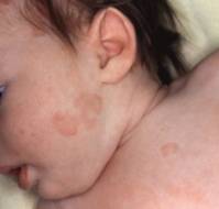 Characterization of GI involvement in childhood-onset SLE