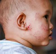Skin and Systemic Infections in Children with Atopic Dermatitis
