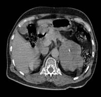 Spontaneous Adrenal Hematoma During Pregnancy: A Case Report
