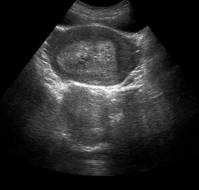 Accuracy of Ultrasound in Diagnosing Retained Products of Conception
