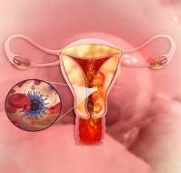 Assessing the Risk of Endometrial Hyperplasia and Cancer in Recurrent Abnormal Uterine Bleeding