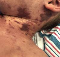A Case of Meningococcal Pericarditis Uncommon Complication of Purpura Fulminans
