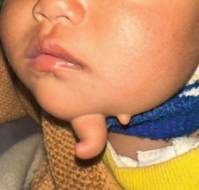 A Rare Case of Faciomandibular Teratoma with Unique Finger-Like Appearance