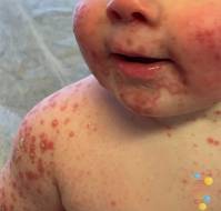 Atopic Dermatitis in Childhood and Pubertal Development: A Nationwide Cohort Study
