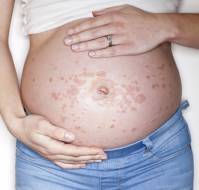 A Case Report of Early-Onset Intrahepatic Cholestasis of Pregnancy