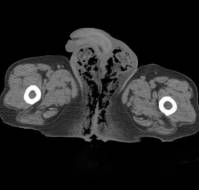 Necrotic Vaginal Pressure Ulcer with Introitus Collapse: Surgical Repair Using Vulvar Flaps