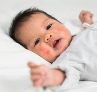 Optimizing Care for Pediatric Patients with Severe Atopic Dermatitis