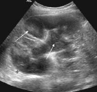 From Hydronephrosis to Pyonephrosis: A Rare Pediatric Case of Urolithiasis