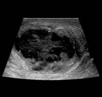 Pediatric Intratesticular Abscess Managed with a Testicular-Sparing Approach: A Case Report