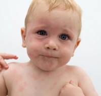  Unmasking Peanut Allergy in the Context of Severe Childhood Atopic Dermatitis