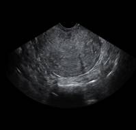 Postmenopausal Ovarian Torsion Mimicking an Abdominopelvic Mass: A Case Report