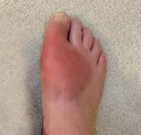 Primary Gout in a 6-Year-Old Girl Presenting as a Foot Mass: A Case Report