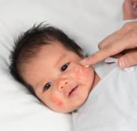 Systemic Targeted Therapies Show Promise for Pediatric Atopic Dermatitis
