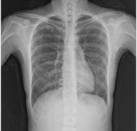 Mycoplasma pneumoniae Pneumonia with Pleural Effusion in a 2-Year-Old Girl