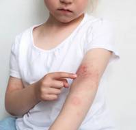 Atopic Dermatitis Impairs Quality of Life in Children