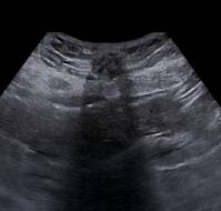 Diagnosis and Surgical Management of Inguinal Endometriosis