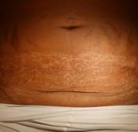 Post-Caesarean Wound Ulceration Due to Pyoderma Gangrenosum