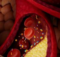 Familial Chylomicronemia Syndrome Presenting as Encephalopathy in an Infant