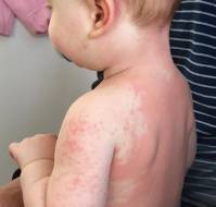 Rising Incidence and Urgent Management Needs of Kawasaki Disease in Children