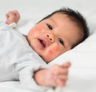 Advances in Pediatric Atopic Dermatitis Management