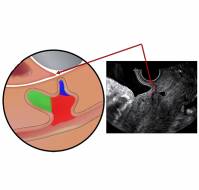 Significance of Uterine Niches in Reducing Complications in Subsequent Pregnancies
