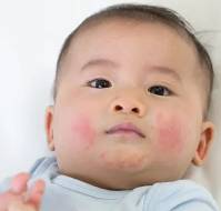 Updated AAP Guidance on Managing Atopic Dermatitis in Children