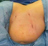 A Case of Abdominal Wound Breakdown Following Appendectomy in Late Pregnancy