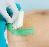 Surgical Approach to Mitigate Risks and Improve Outcomes in Cesarean Section