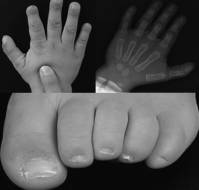 Diagnosis and Management of HPMRS3 in a 2-Year-Old Boy with Developmental Delay and Elevated Alkaline Phosphatase