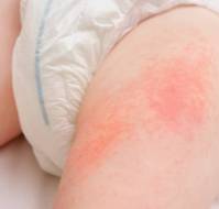 Traditional and Modern Practices in Managing Diaper Dermatitis in Young Children