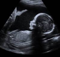 Nuchal Translucency as a Predictor of Congenital Heart Defects in Early Pregnancy