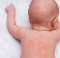 The Infection Connection: Insights into Atopic Dermatitis in Children 