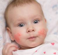 Skin and Systemic Infections in Children with Atopic Dermatitis