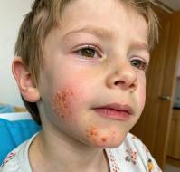 Contact Dermatitis to a Topical Antibiotic after Skin Injury